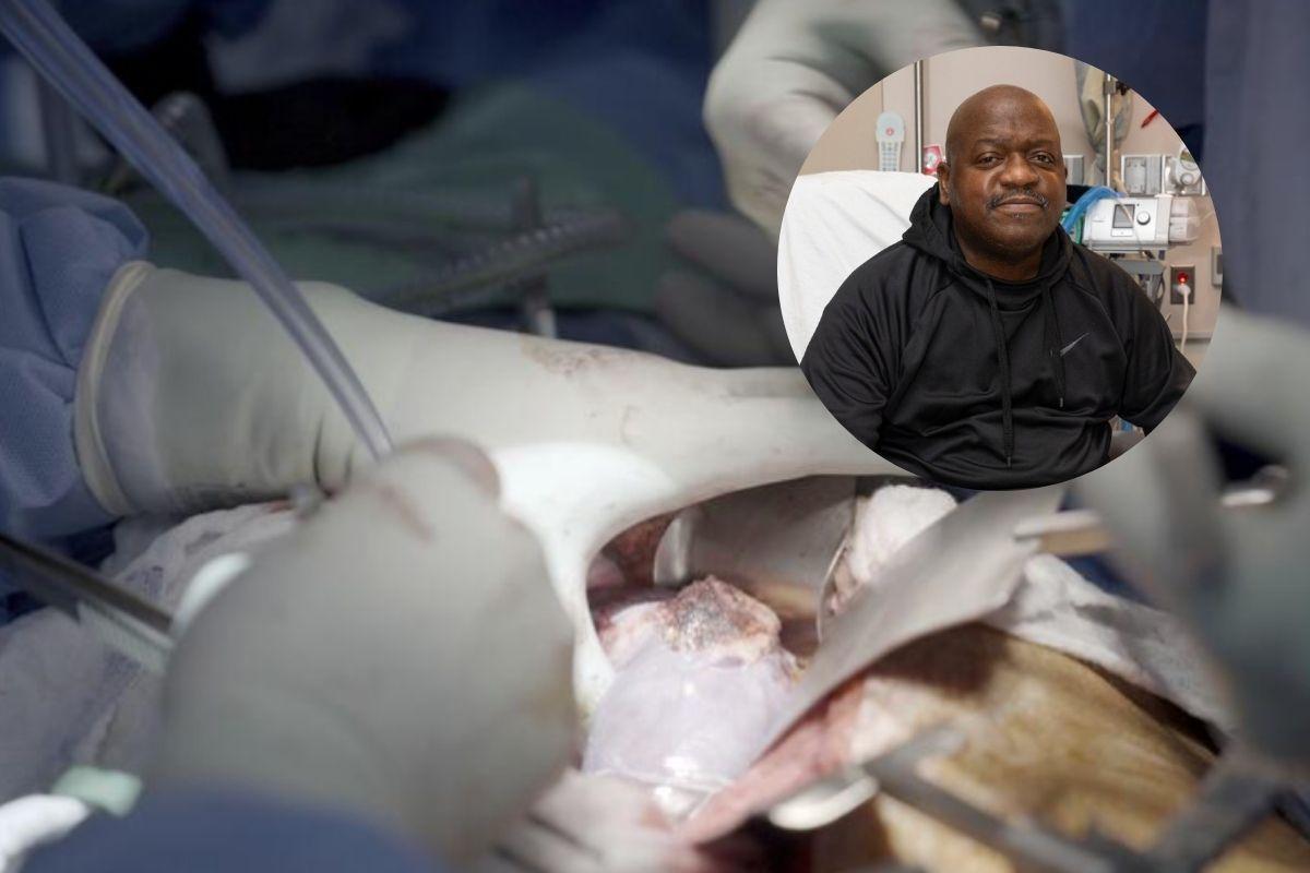 Primer paciente con trasplante de riñón de cerdo fue dado de alta